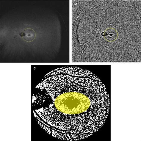 A Example Of A Fundus Autofluorescence Image Of A 61 Year Old Man