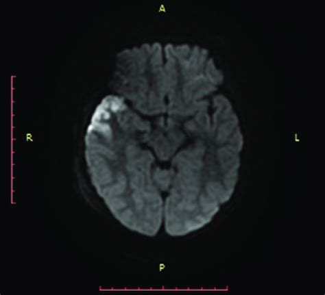 Initial Mri Scan Axial Dwi Depicting Restriction Of Diffusion Signal