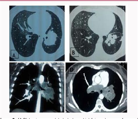 Figure 2 From Pulmonary Artery Sarcoma Intimal Mimicking Embolism Lung