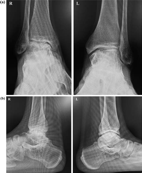 Figure 1 From A Case Of Arthroscopic Ankle Arthrodesis For Hemophilic