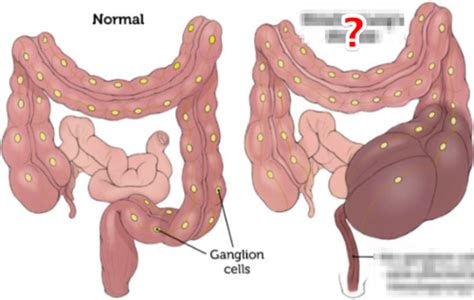 7 Diverticulosis Of The Colon Pathology Of Colonic Polyps Flashcards Quizlet