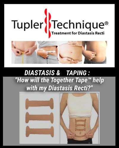 The Benefits Of Tape For Diastasis Rectificacions And Treatments