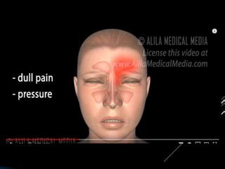 Nasal Septal Hematoma Wikipedia, 52% OFF