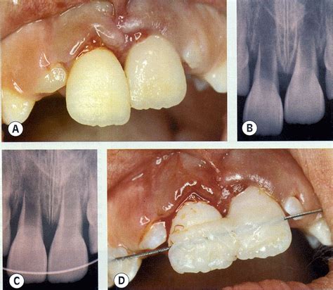 Control Y Manejo De Las Luxaciones Dentales Directorio Odontol Gico