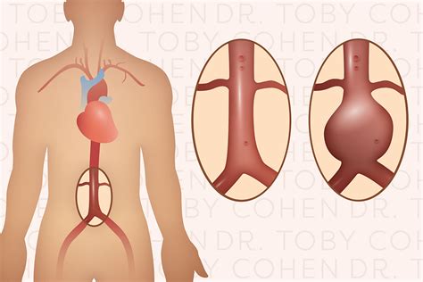 Aortic Aneurysms Dr Toby Cohen