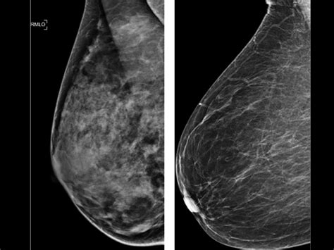 Mammogram study: Dense breasts won't raise cancer death risk in women ...