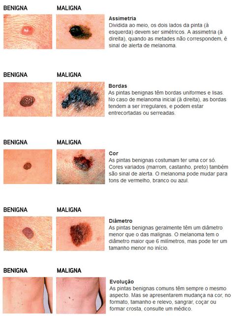 Pintas E Sinais Quando Remov Los Midas Medicina Est Tica No Centro Rj