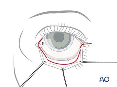 Transconjunctival Lower Eyelid Approaches