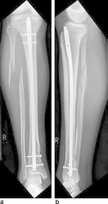 Anterio Posterior A And Medio Lateral B Radiographs Of The Right