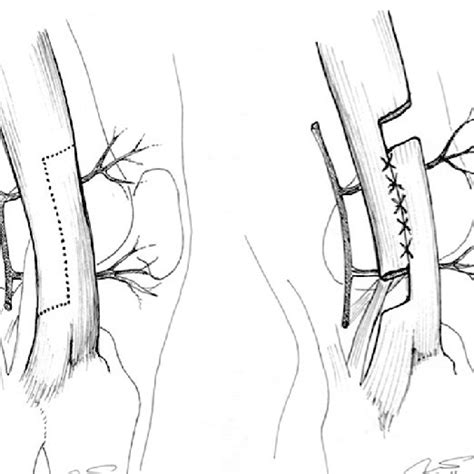 Schematic Diagram Showing A Approach Over The Iliotibial Band To