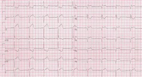 Right bundle branch block EKG examples - wikidoc