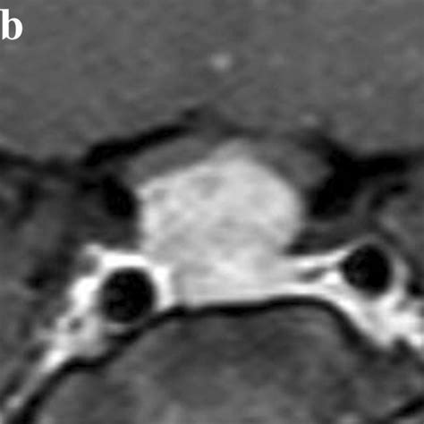 Treatment effect of cabergoline on giant prolactinoma. Coronal T2 MRI ...