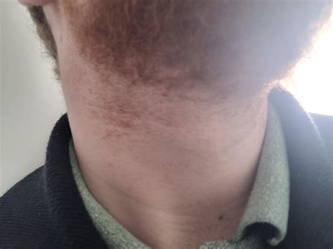 What Should I Do About The Red Bumps On My Neck After Shaving R