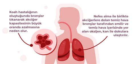 KOAH Nedir ve Nasıl Tedavi Edilir