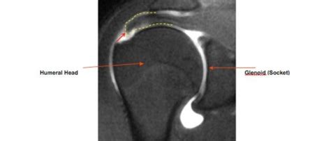 Boston Shoulder Institute – humeral-head