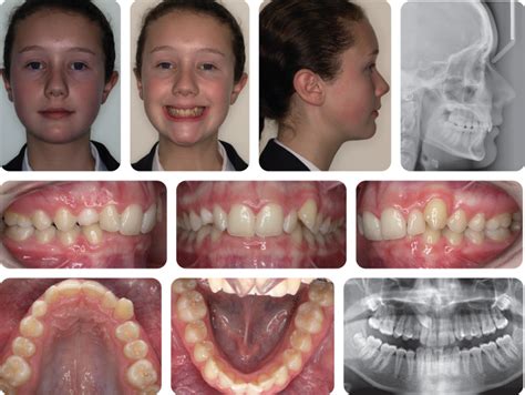 5 Class Ii Division 2 Malocclusion Pocket Dentistry