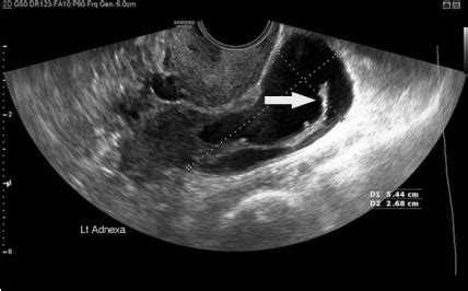 Reason Of Female Infertility Sunway Fertility Centre Ivf