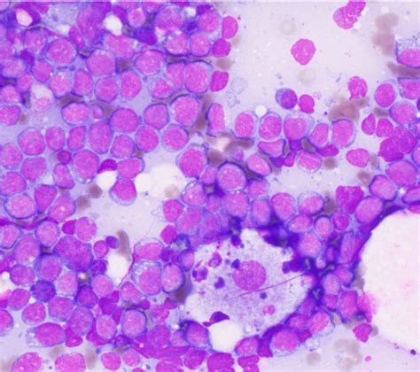 Pathology Outlines Burkitt Lymphoma