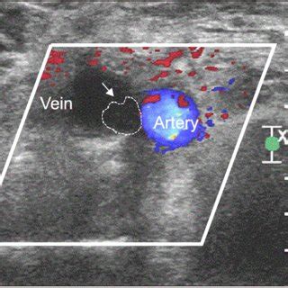 Acute popliteal DVT on venous ultrasound. The popliteal vein is not ...