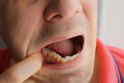 Is A Tooth Abscess An Emergency