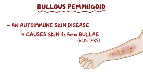 Bullous Pemphigoid