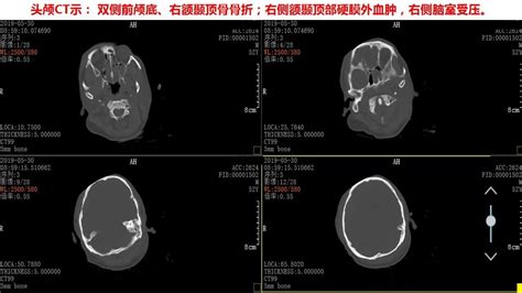 一例重型颅脑损伤患者急诊救治及早期康复治疗体会 颅脑创伤 神经重症病例周刊（138期） 脑医汇 神外资讯 神介资讯