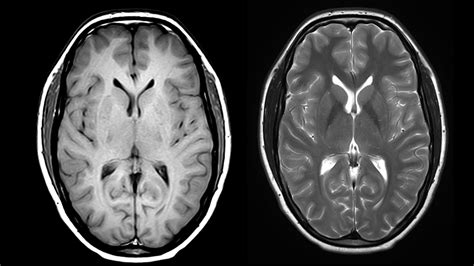 Resonancia Magn Tica De Cabeza Qu Necesito Saber Blog Midiagnostico