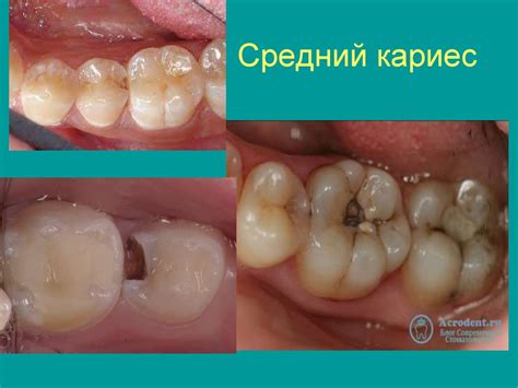 Лечение кариеса - презентация онлайн