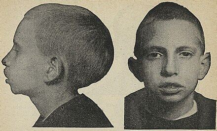 Dolichocephaly - Wikipedia