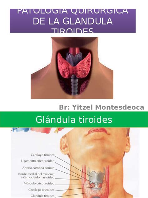 Patologia De La Tiroides Tiroides Cáncer