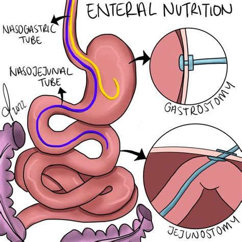 Perioperative Nutrition TeachMeSurgery