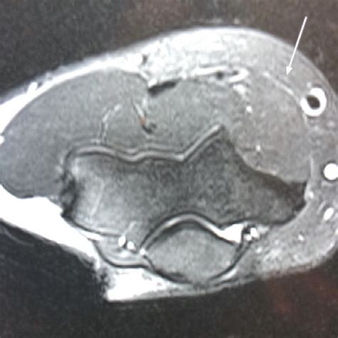 Illustration Of The Volar Forearm And The Compression That Can Occur