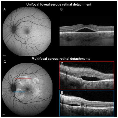 Serous Macular Detachment