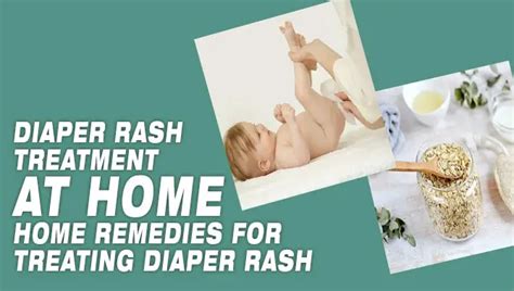 Diaper Rash Treatment At Home: Home Remedy Mastery