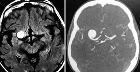 A Axial Mri Flair Sequence Showing The Lesion S Hypersignal Located Download Scientific