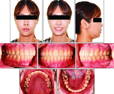 Post Retention 2 Years Facial And Intraoral Photographs Download Scientific Diagram