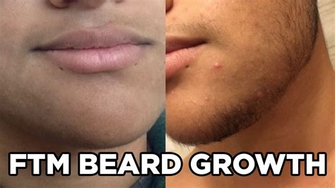 Ftm Beard Growth Timeline Youtube