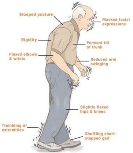 Ch 69 Parkinson S Disease PD Flashcards Quizlet