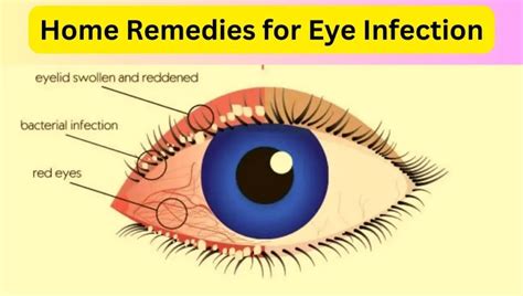 Effective Home Remedies For Eye Infection