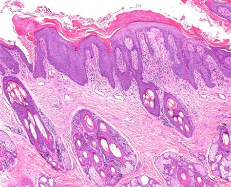 Hepatocutaneous Syndrome In A Maltese Diagnosis Treatment And The