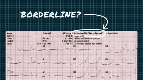 What Borderline Means On Your ECG Qaly