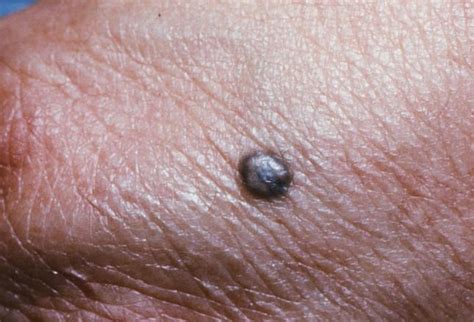 Mole Or Melanoma Test Yourself With These Suspicious Lesions