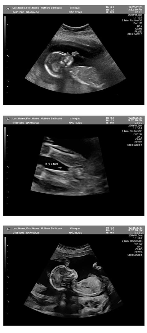 16 Weeks Ultrasound Girl 3 Fetuses Ultrasounds