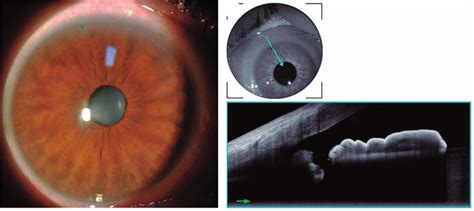 Anterior Segment Biomicroscopy Highlights The Laser Peripheral