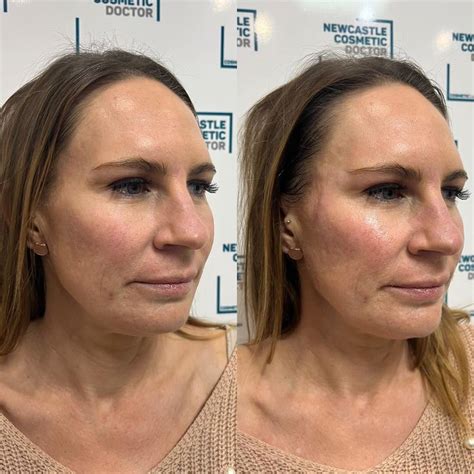 Dermal Fillers Jawline Temple Temples