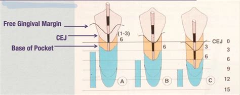 D1q3 Perio Periodontal Exam And Diagnosis By Dr Bezerra Flashcards Quizlet