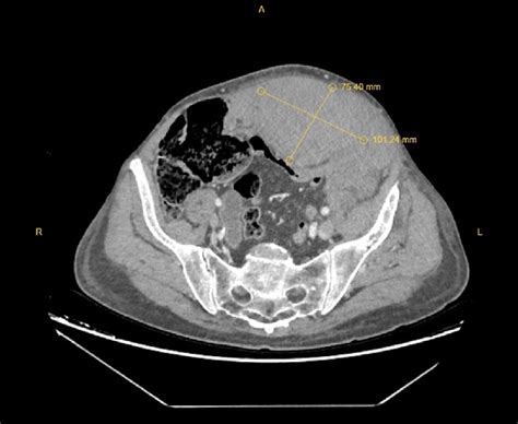 Axial Computed Tomography Image Of The Abdomen Pelvis With The Diameter