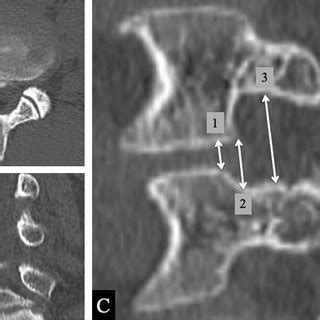 Reconstructed Axial A Coronal B And Sagittal C Ct Images Of The