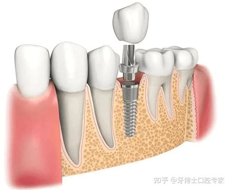 做全口种植牙需要多少钱？全口种植牙需要种多少颗牙？ 知乎