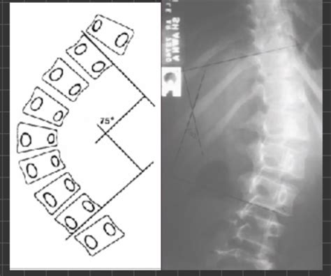 Thoracic Spine Lect Flashcards Quizlet